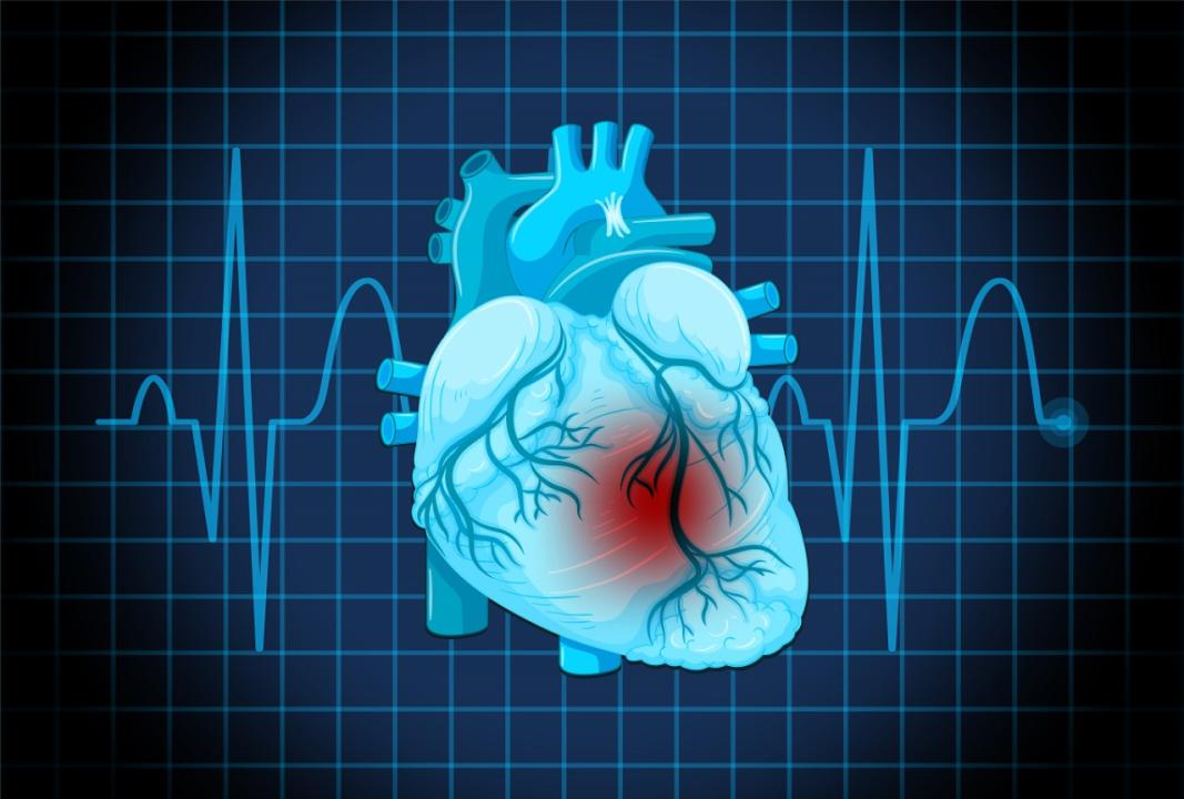 Son 50 İldə Ürək Tutmasından Ölüm Halları 90% Azalıb: Mütəxəssislər Üç Xəstəlik Riskinə Diqqət Çəkir